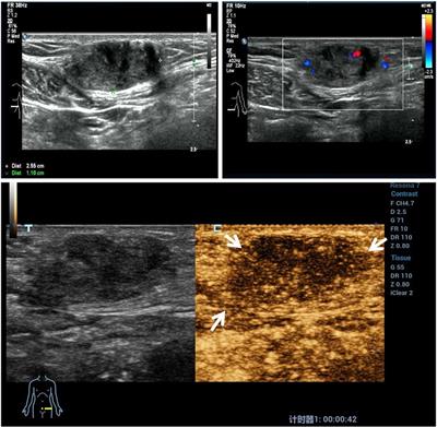Safety and efficacy of microwave ablation for abdominal wall endometriosis: A retrospective study